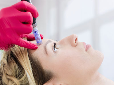 Microneedling in Rochester