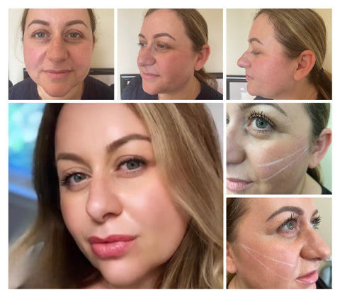 SMYLIQUE trade  Dentistry | Same Day Teeth Whitening, Facial Threading and Juvederm reg 